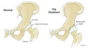 دیسپلازی (بد شکل گیری) مفصل لگن (هیپ)