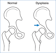 دیسپلازی (بد شکل گیری) مفصل لگن (هیپ)