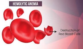 علت اول زردی در نوزادان: تخریب گلوبول‌های قرمز خون | تخریب گلبول قرمز در خون یا طحال