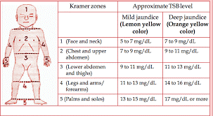 بدن نوزاد به پنج ناحیه یا زون تقسیم شده است. در صورتی که مقدار بیلی‌روبین خون در حد پایین باشد زردی فقط در سر چشم و صورت مشاهده می‌شود.