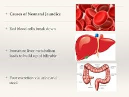 سه علت اصلی تولید زردی در نوزاد